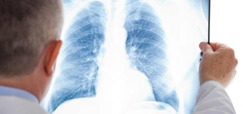Що таке туберкульоз, його ознаки, шляхи передачі та лікування